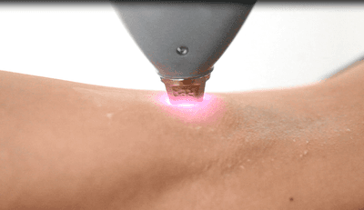 Sessão de depilação laser díodo